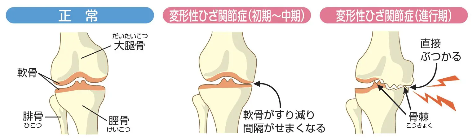 変形性膝関節症|おかざき足の血管外科・痛みのクリニック|愛知県岡崎市